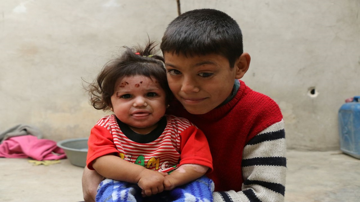 بالصور: معاناة عائلة سورية..طفل فقد عينه وأخته احترقت